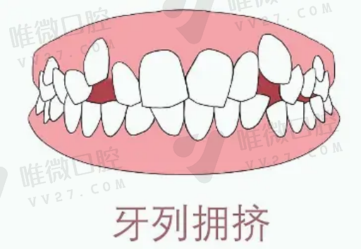 塑钢牙与树脂牙哪个好（塑钢牙图片大全价格表）(图1)